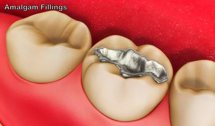 Amalgam Fillings