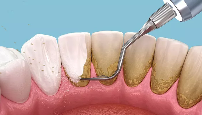 Dental Floss Remove Plaque